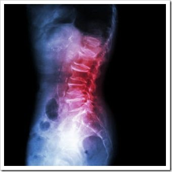Back Pain Warren OH Arthritis