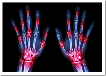 Rheumatoid Arthritis Solutions Warren OH